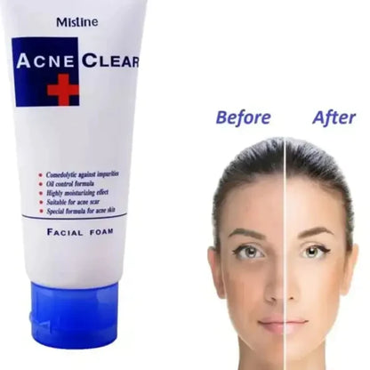 Acne Clear Facial Foam